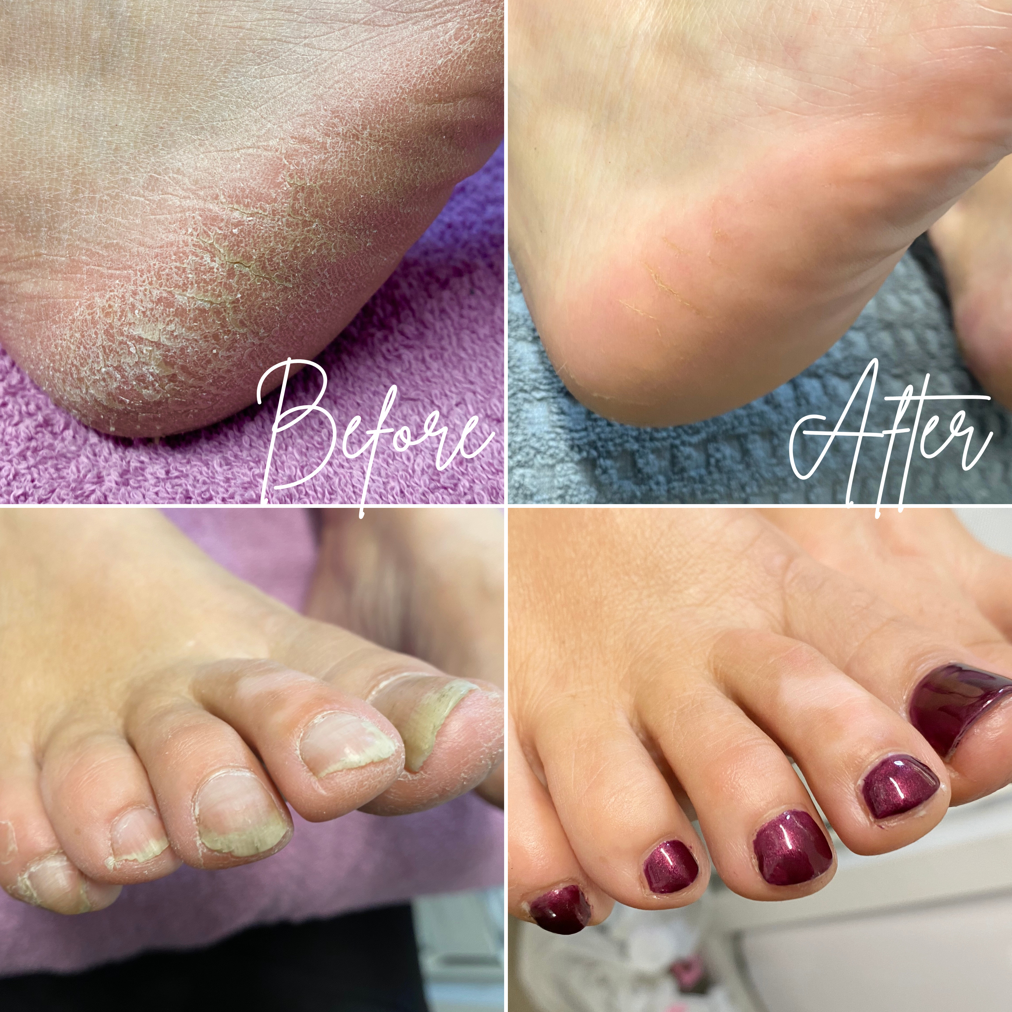 footlogix before and after